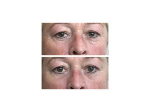 InstanTENSE Plus emelő hatású szérum (25 ml)